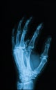 X-ray image of broken hand, oblique view. Royalty Free Stock Photo