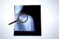 X-ray image broken human collarbone is viewed through magnifying glass