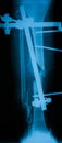 X-ray image of broken leg, AP view. Royalty Free Stock Photo