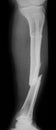 X-ray image of broken leg, AP view.