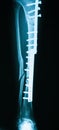 X-ray image of broken leg, AP view. Royalty Free Stock Photo