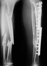 X-ray image of broken leg, lateral view. Royalty Free Stock Photo