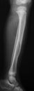 X-ray image of broken leg, lateral view. s Royalty Free Stock Photo