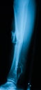 X-ray image of broken leg, lateral view. Royalty Free Stock Photo