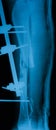 X-ray image of broken leg, lateral view. Royalty Free Stock Photo