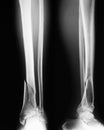 X-ray image of broken leg, Show tibia and fibula fractures.