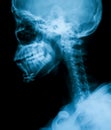 X-ray image of broken mandible ,lateral view