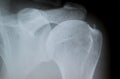 X-Ray image of calcified shoulder Tendinosis calcarea Royalty Free Stock Photo