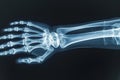 This x-ray image captures the intricate detail and structure of a skeletons hand, A 3D X-ray of a human wrist with a fracture, AI Royalty Free Stock Photo