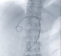 X-ray image of catheter in Upper abdomen