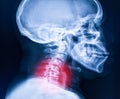 X-ray image of cervical spine, neck x-ray image Royalty Free Stock Photo