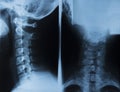 X-ray image of the cervical spine of a woman with osteochondrosis Royalty Free Stock Photo