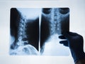 X-ray image of the cervical spine of a woman with osteochondrosis and displacement of the vertebrae Royalty Free Stock Photo