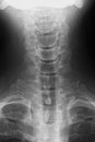 X-ray image of cervical vertebrae, frontal view