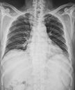 X-Ray Image Of Chest