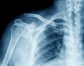X-ray image chest Royalty Free Stock Photo