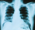X-ray image of chest bones