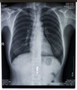 X-ray image of chest