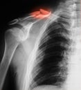 X-ray image of clavicle, AP view.