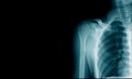 X-ray image clavicle fracture