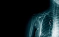 X-ray image clavicle fracture