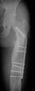 X-ray image of femur fracture, lateral view,
