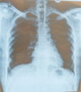 X-Ray image film of adult chest screening Royalty Free Stock Photo