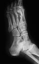 X-ray image of foot, oblique view.