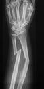 X-ray image of forearm, AP view (Antero-posterior view, show fracture of ulna and radius