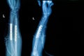 X-ray image of forearm with implant