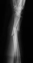 X-ray image of forearm,lateral view, show fracture of ulna and r