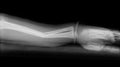 X-ray image of forearm and wooden splint, lateral view.