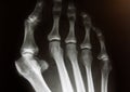 X-Ray image of forefoot with hallux valgus deformity Royalty Free Stock Photo