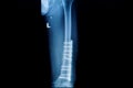 x-ray image of fracture leg ( femur )with implant plate and Royalty Free Stock Photo