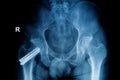 X-ray image of fracture leg ( head of femur ) Royalty Free Stock Photo
