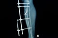 X-ray image of fracture leg ( tibia )with implant Royalty Free Stock Photo