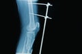 X-ray image of fracture leg ( tibia ) Royalty Free Stock Photo