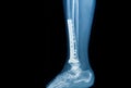 X-ray image of fracture leg (tibia )with implant Royalty Free Stock Photo