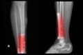 X-ray image of fracture leg (tibia ) Royalty Free Stock Photo