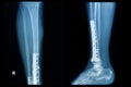 X-ray image of fracture leg (tibia )with implant plate Royalty Free Stock Photo