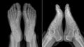 X-ray image of the girl's feet (two views with partially outline