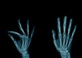 x-ray image hand and finger Royalty Free Stock Photo