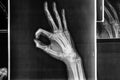 X-ray hands with OK sign