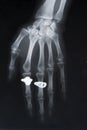 X-ray image of hand with two rings Royalty Free Stock Photo
