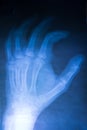 X-Ray image hands Royalty Free Stock Photo
