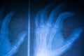 X-Ray image hands Royalty Free Stock Photo