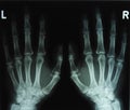 X-ray image of the hands Royalty Free Stock Photo