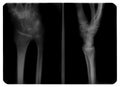 X-ray image of healed hand Royalty Free Stock Photo