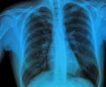 Xray lung Royalty Free Stock Photo