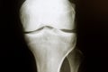 X-ray image of healthy regular knee with normal joint space negative results